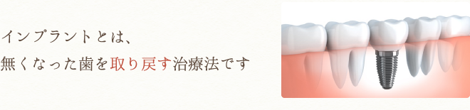 インプラントとは、無くなった歯を取り戻す治療法です