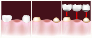 失った歯の両隣りの健康な歯を削ってかぶせ物をする